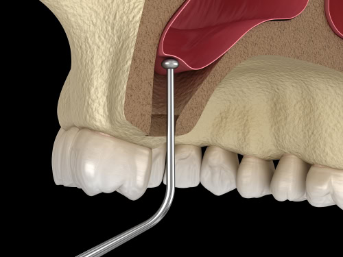 Sinus Lift in Wayne, NJ | Free Implant Consultations Near Me
