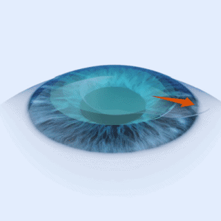 Lasermethoden 3 Smart_Sight