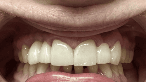 Mini Dental Implants in Scottsdale, AZ Dr. Seerat Mann