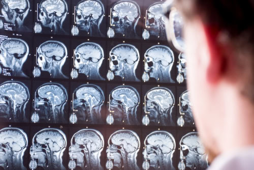 Brain Injury Lawyers in Buffalo, NY Lipsitz, Ponterio & Comerford, LLC