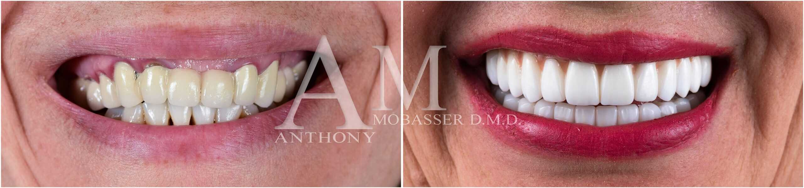 Full Mouth Reconstruction in Los Angeles - Before and After Full Mouth Reconstruction
