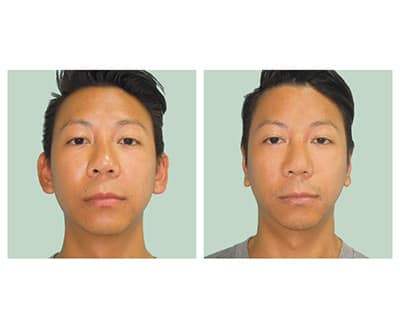 otoplasty-before-after-5