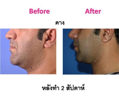 vaser-liposuction3_mini