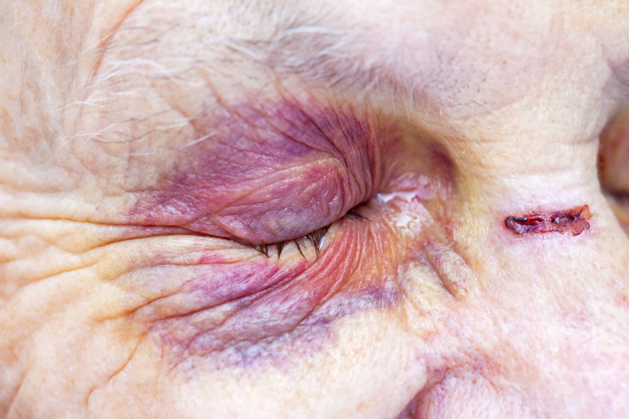 外籍看護|雲縣外籍看護施暴長者 勞青處協助後續 老年人眼部皺紋與傷口,展現高齡健康護理與醫療需求。.