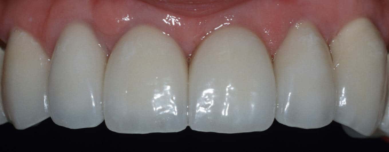 upper anterior bridge