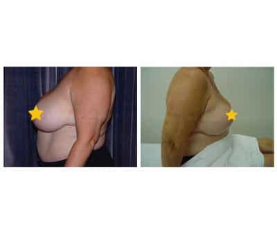breast-reduction3_mini